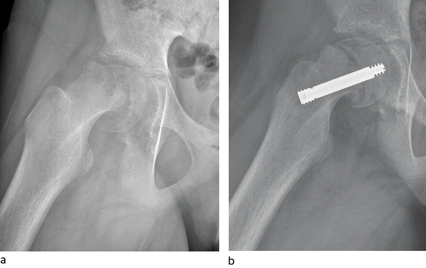 Figur 2 H&oslash;yresidig ustabil epifysiolysis capitis femoris behandlet med skruefiksasjon. En del av feilstillingen reponerte&hellip;
