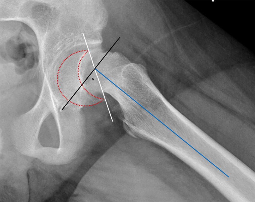 Figur 4 Glidningsvinkelen (a) m&aring;les p&aring; sidebilde (epifysen er markert med stiplet linje) og er vinkelen mellom epifyseskiven&hellip;