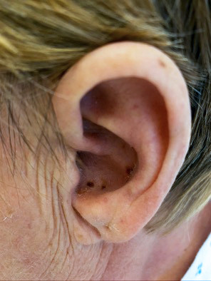 Figur 1 Utslett med vesikler og kruster i &oslash;remuslingen venstre side.