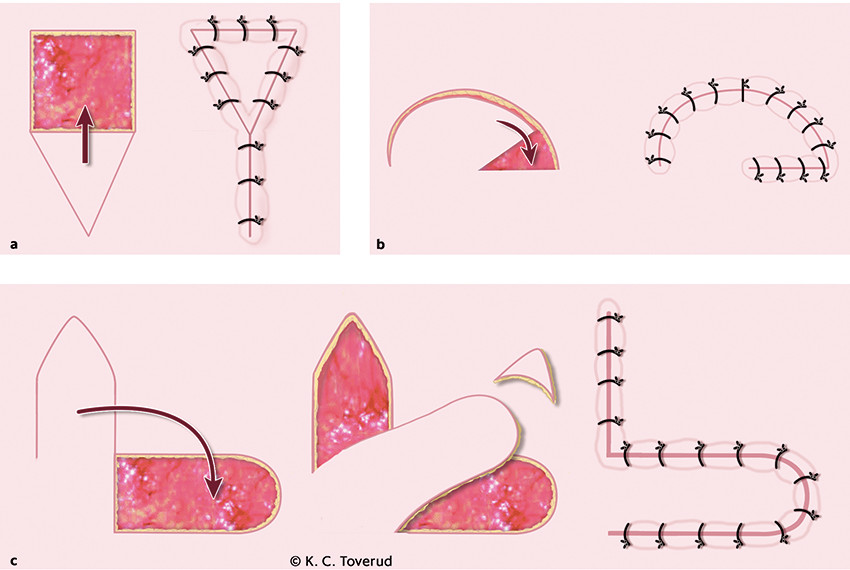 Figure 1 Examples of local skin flaps that can be used for reconstruction of wound defects. The figure shows the wound&hellip;