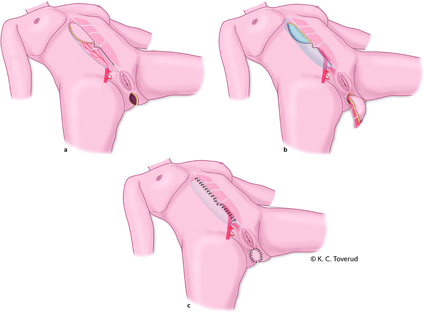 Figure 3 Wound defect after resection of the rectum and anus which has been reconstructed with a vertical rectus abdominis&hellip;