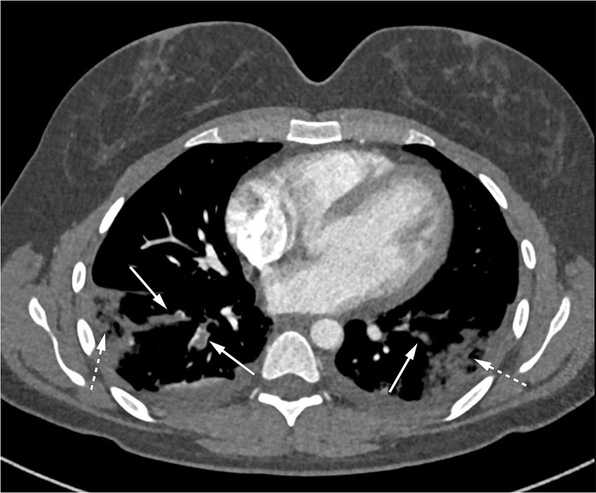 Figur 1 CT thorax med kontrast viser bilaterale lungeembolier (heltrukne piler) og perifere fortetninger forenlig med&hellip;