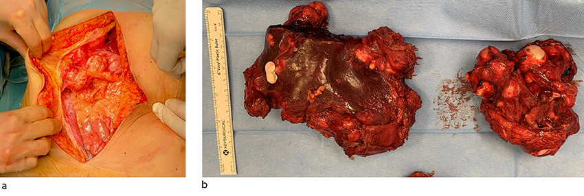 Figur 2 Bilder tatt under operasjon. a) bukvegg med adherente cyster, b) operasjonspreparat: til venstre leverresektat med&hellip;