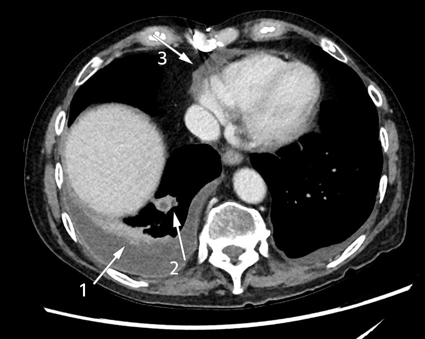 Figur 1 CT thorax med intraven&oslash;st kontrastmiddel viser kontrastoppladning i pleura, empyemsuspekt pleurav&aelig;ske basalt p&aring;&hellip;