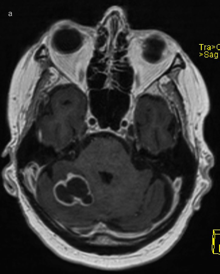Figure 2 Cerebral abscesses visualised on contrast-enhanced MRI. T1-weighted sequence with intravenous contrast reveals a&hellip;