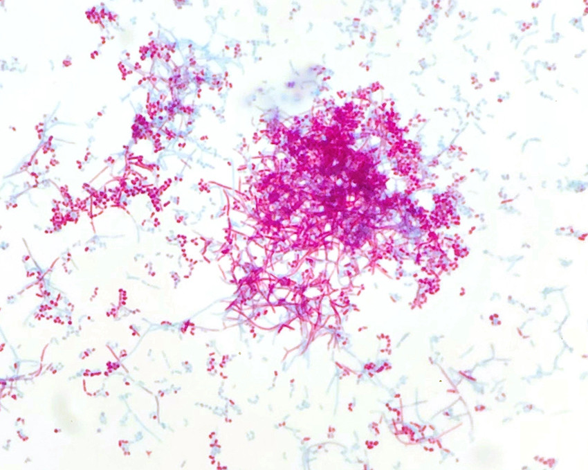 Figure 4 Ziehl-Neelsen staining of colonies from the cerebral abscess reveals partially acid-fast rods with branching&hellip;