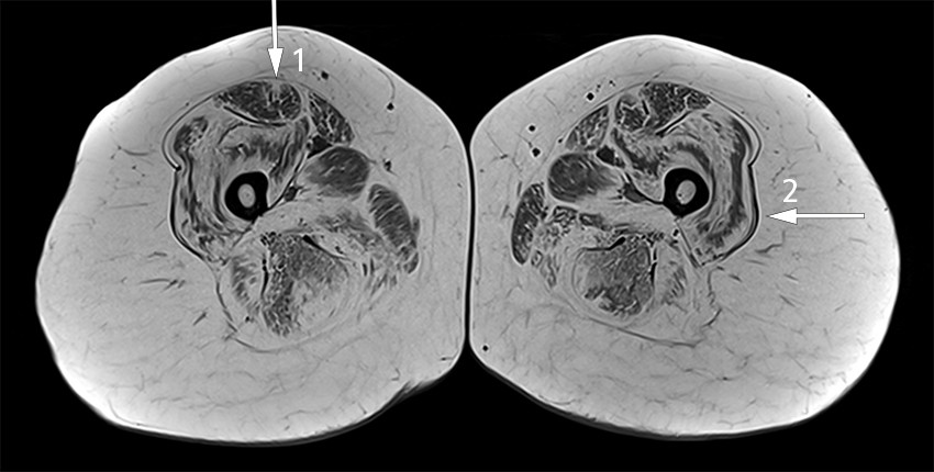 Figure 1 Transversal T1-weighted MRI image of the thighs reveals symmetrical pathological fatty infiltration in the muscles&hellip;