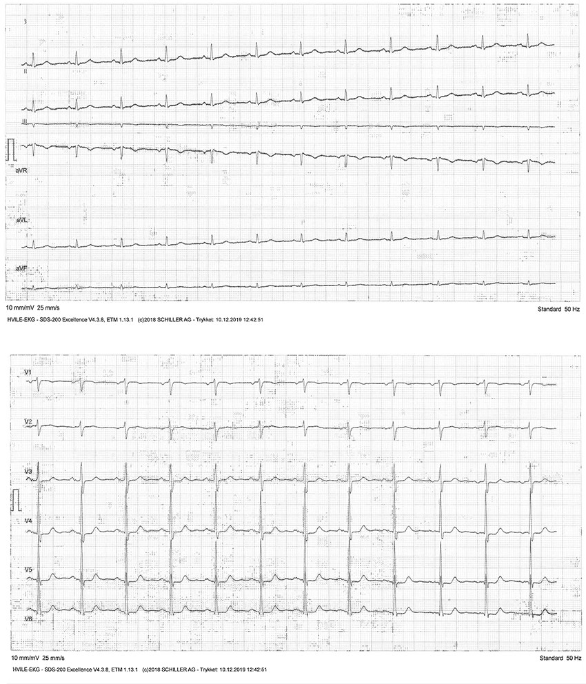 Figure 1 Resting ECG showing sinus rhythm and a normal electrical axis in all 12 leads.