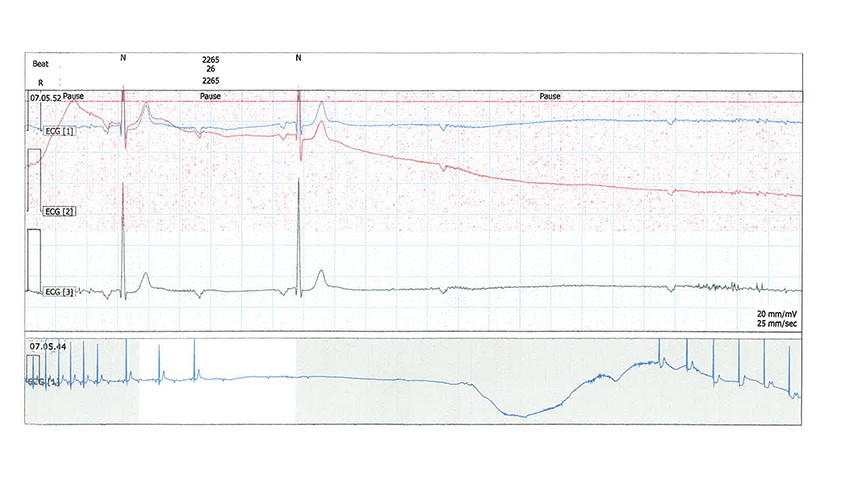 Figur 2 24-timers EKG p&aring; det tidspunktet pasienten ble bevisstl&oslash;s viser bortfall av QRS-komplekser, etterfulgt av total AV&hellip;