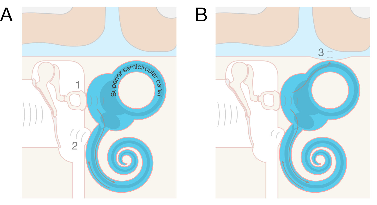 Figure 1 Pathophysiology of superior semicircular canal dehiscence. A) Normal anatomy: Two compliant areas in the labyrinth &hellip;