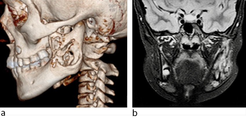 Figur 1 Pasient 1. a) 3D-rekonstruksjon etter CT viser omfattende destruksjon av venstre ramus mandibula. b) Inflammatoriske&hellip;