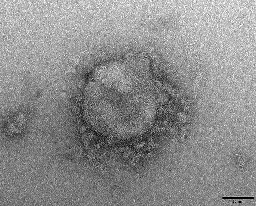 Figure 1 SARS-CoV-2 virus detected on transmission electron microscopy (180,000 &times; magnification) in specimen material from&hellip;