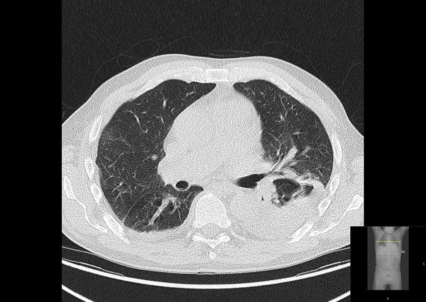 Figure 2 The CT component (axial section) of the PET-CT scan of the mid lung zones reveals an infiltrate in the left lower&hellip;