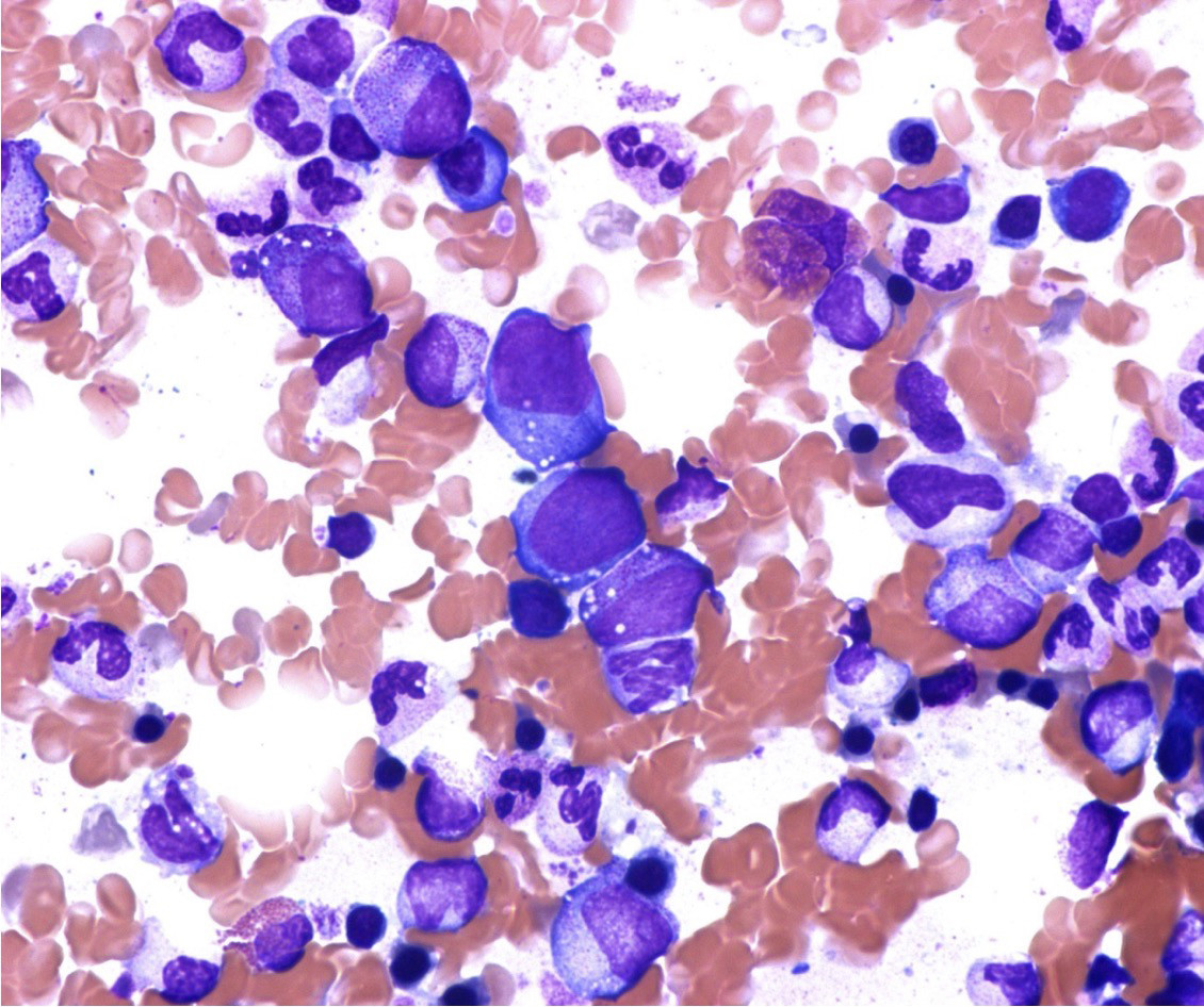 Figur 3 Vakuolisering i erytroide og myeloide forl&oslash;pere. Foto: Signe Spetalen, Oslo universitetssykehus.