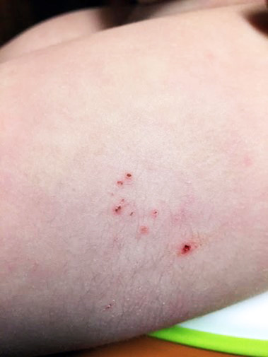 Figure 1 The patient's lateral left thigh with distinct hair growth and chronic eczema.