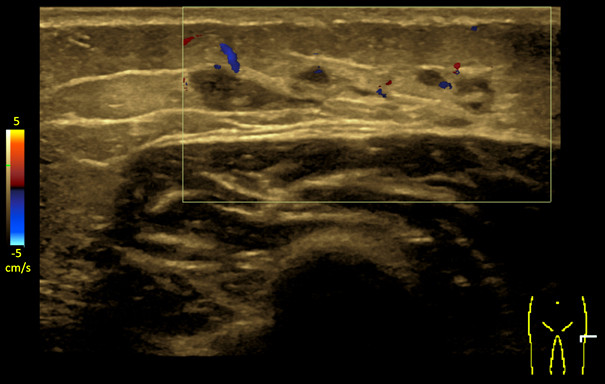 Figure 2 The ultrasound image shows a large subcutaneous, tubular hypoechoic lesion without a Doppler signal.