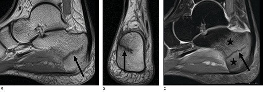 Figur 2 Stressfraktur posteriort i calcaneus fremstilles p&aring; MR som en line&aelig;r, m&oslash;rk signalforandring (pil) her p&aring;&hellip;