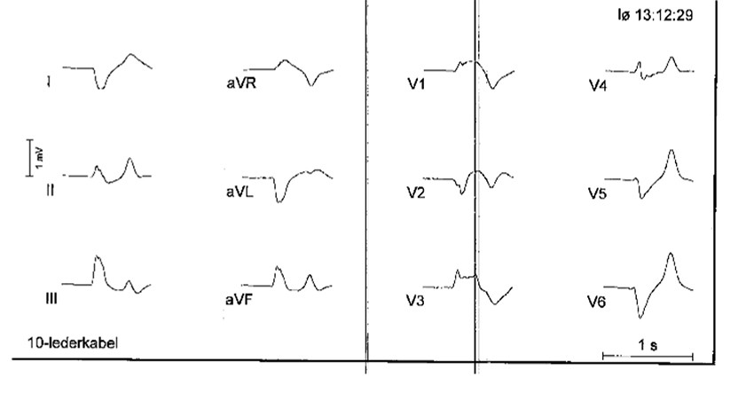 Figur 1 Prehospitalt EKG viser breddefor&oslash;ket QRS-kompleks og frav&aelig;r av P-b&oslash;lger. QRS-komplekset kan lett mistolkes som et ST&hellip;