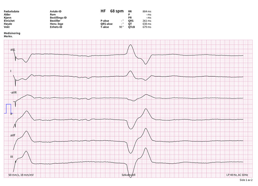 Figur 2 EKG tatt ved ankomst akuttmottak. Alvorlig bradykardi med aksjon p&aring; 23 slag/minutt. Sv&aelig;rt breddefor&oslash;ket QRS-kompleks&hellip;