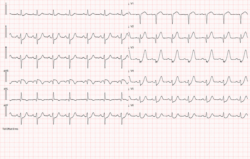 Figur 1 EKG (25&nbsp;mm/sek) tatt ved ankomst lokalsykehuset viser oppadstigende ST-senkning i avledningene V2&ndash;V5, som i V3&ndash;V4&hellip;