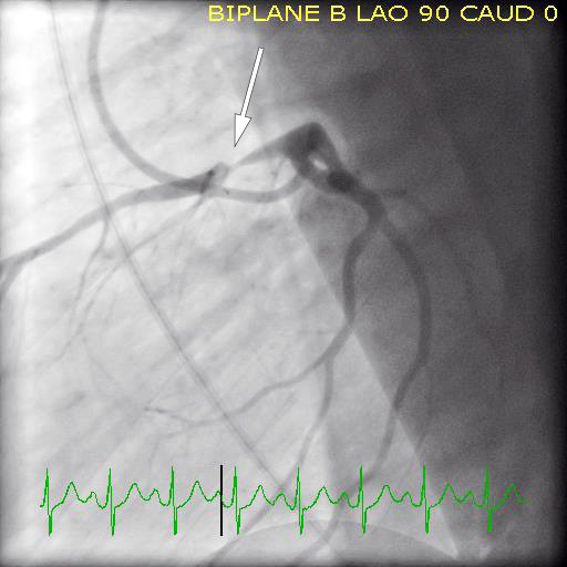 Figur 2 Koronar angiografi viser tr&aring;dtynn stenose (pil) i venstre fremre koronararterie (LAD).
