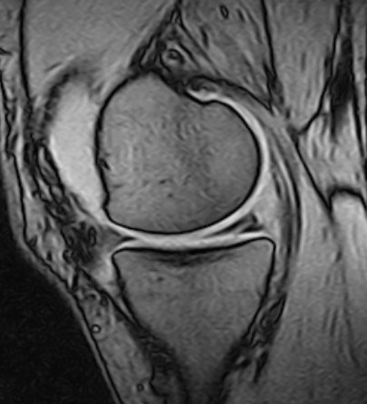 Figure 1 MRI of the knee, sagittal plane, showing a degenerative tear in the posterior horn of the medial meniscus. Photo:&hellip;