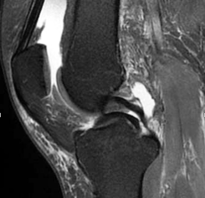 Figure 3 MRI of the knee, sagittal plane, showing a folded bucket-handle tear in the medial meniscus. Photo: Martina Hansens&hellip;