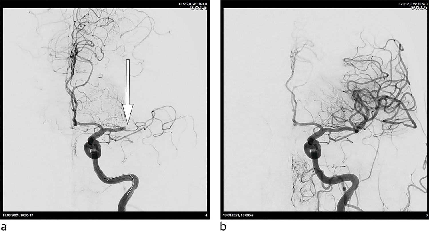 Figur 2 Cerebral invasiv angiografi av en okkludert a. cerebri media f&oslash;r (a) og etter (b) mekanisk trombektomi.