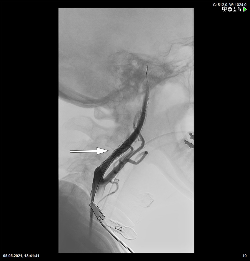 Figur 3 Stent plassert i a. carotis interna.