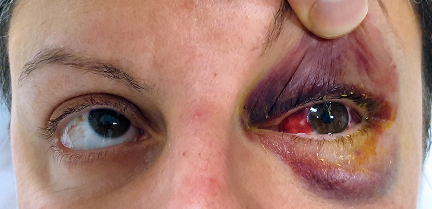 Figure 2 Patient photograph showing restricted movement of the left eye on upward gaze due to orbital floor fracture. The&hellip;