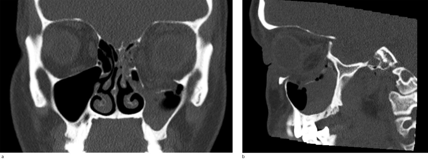 Figure 3 CT of left orbital floor fracture in a) coronal plane and b) sagittal plane.