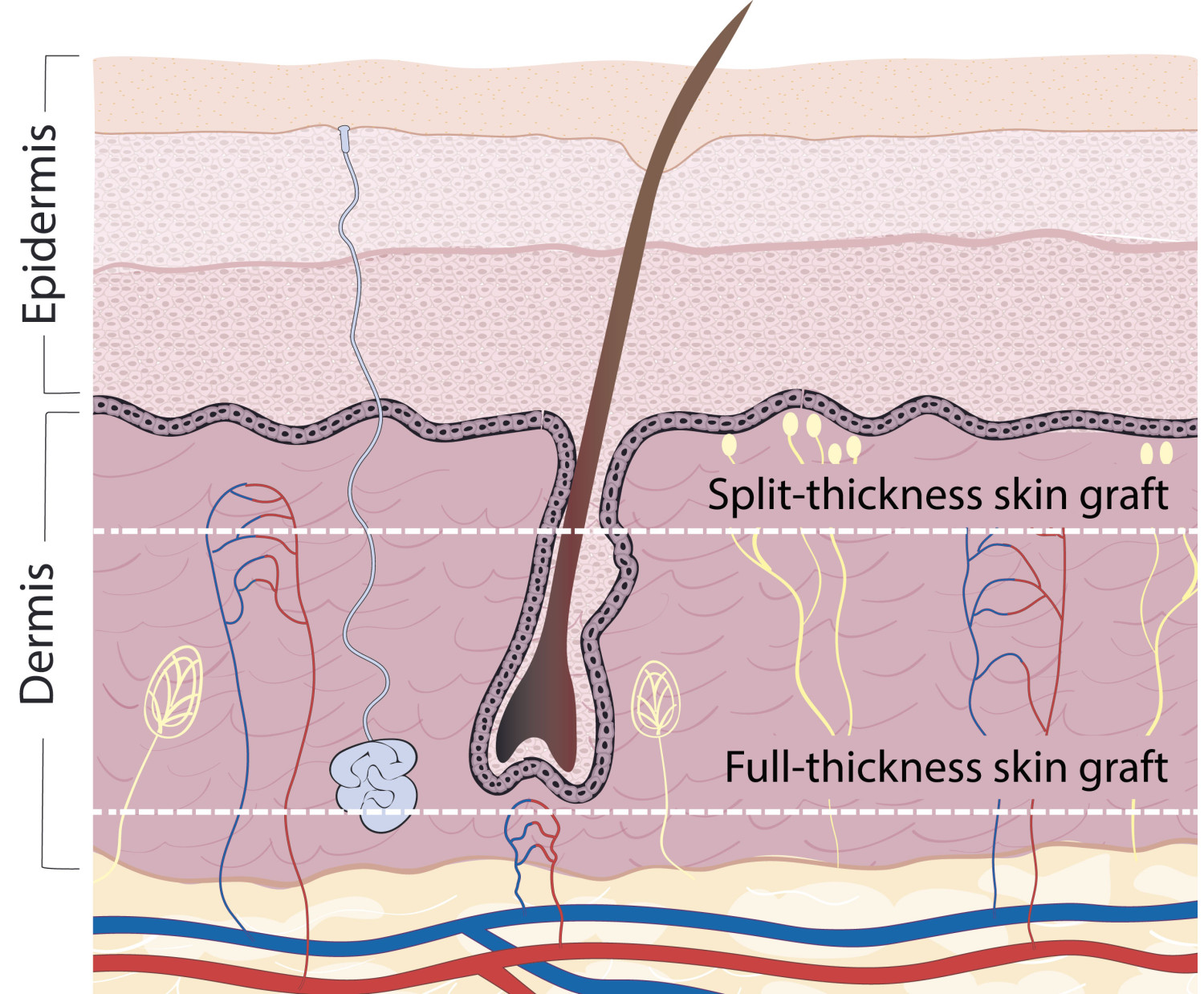 Figure 2 Skin grafts are classified as full-thickness or split-thickness skin grafts based on the thickness of the skin&hellip;