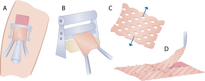 Figure 3 The figure shows the steps in split-thickness skin grafting with skin harvesting from a donor site (A), meshing of&hellip;