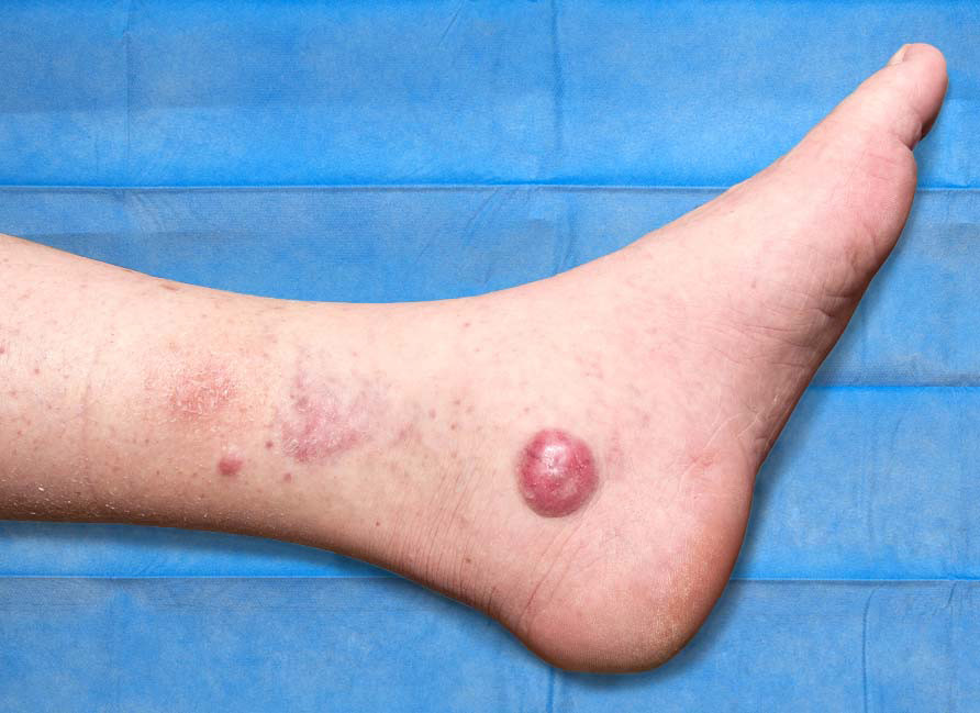 Figure 1 Cutaneous metastasis from Merkel cell carcinoma.