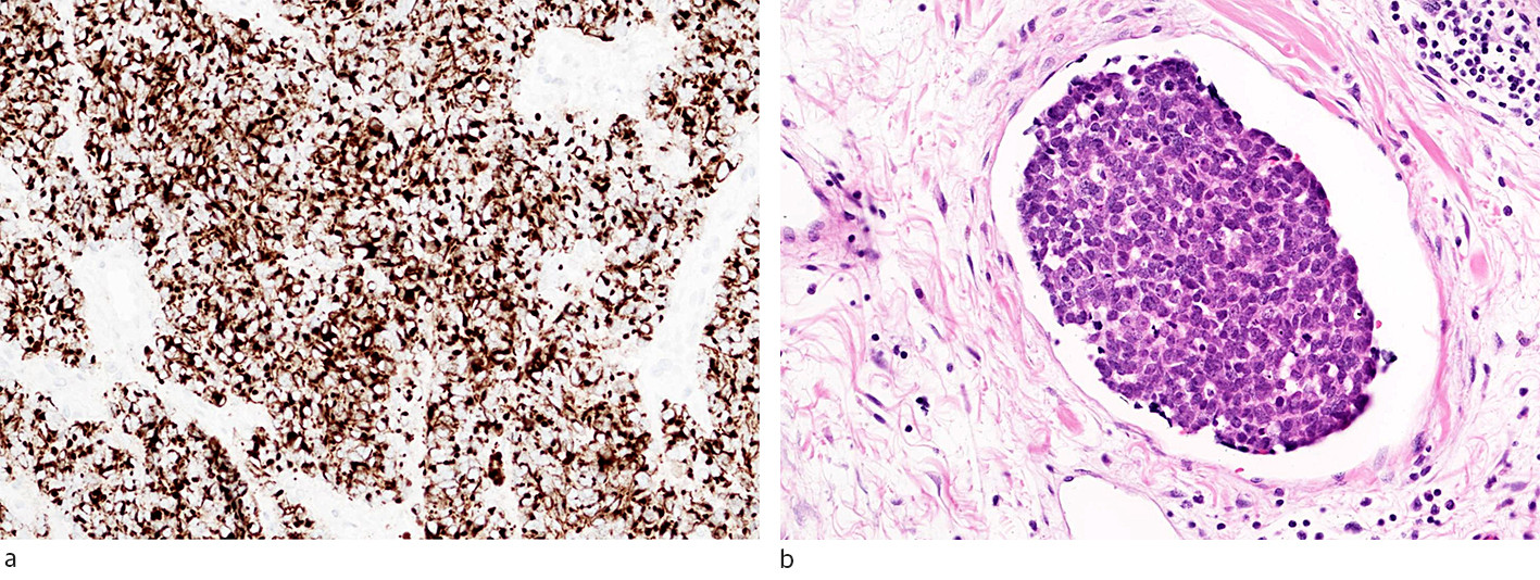 Figur 2 a) Immunhistokjemisk unders&oslash;kelse av merkelcellekarsinom med mark&oslash;ren CK20 (cytokeratin 20), som ofte viser&hellip;
