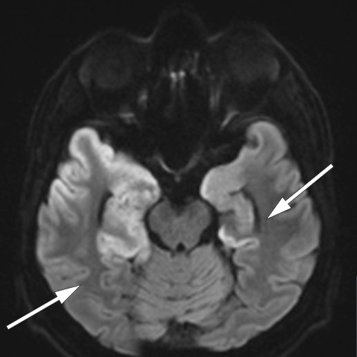 Figure 2 Transverse section of diffusion-weighted MRI six days after admission shows cortical thickening with reduced&hellip;