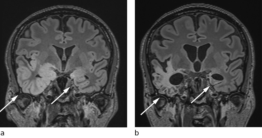 Figure 3 MRI with coronal T2-weighted FLAIR sequences. a) Six days after the first admission, hyperintense cortical&hellip;