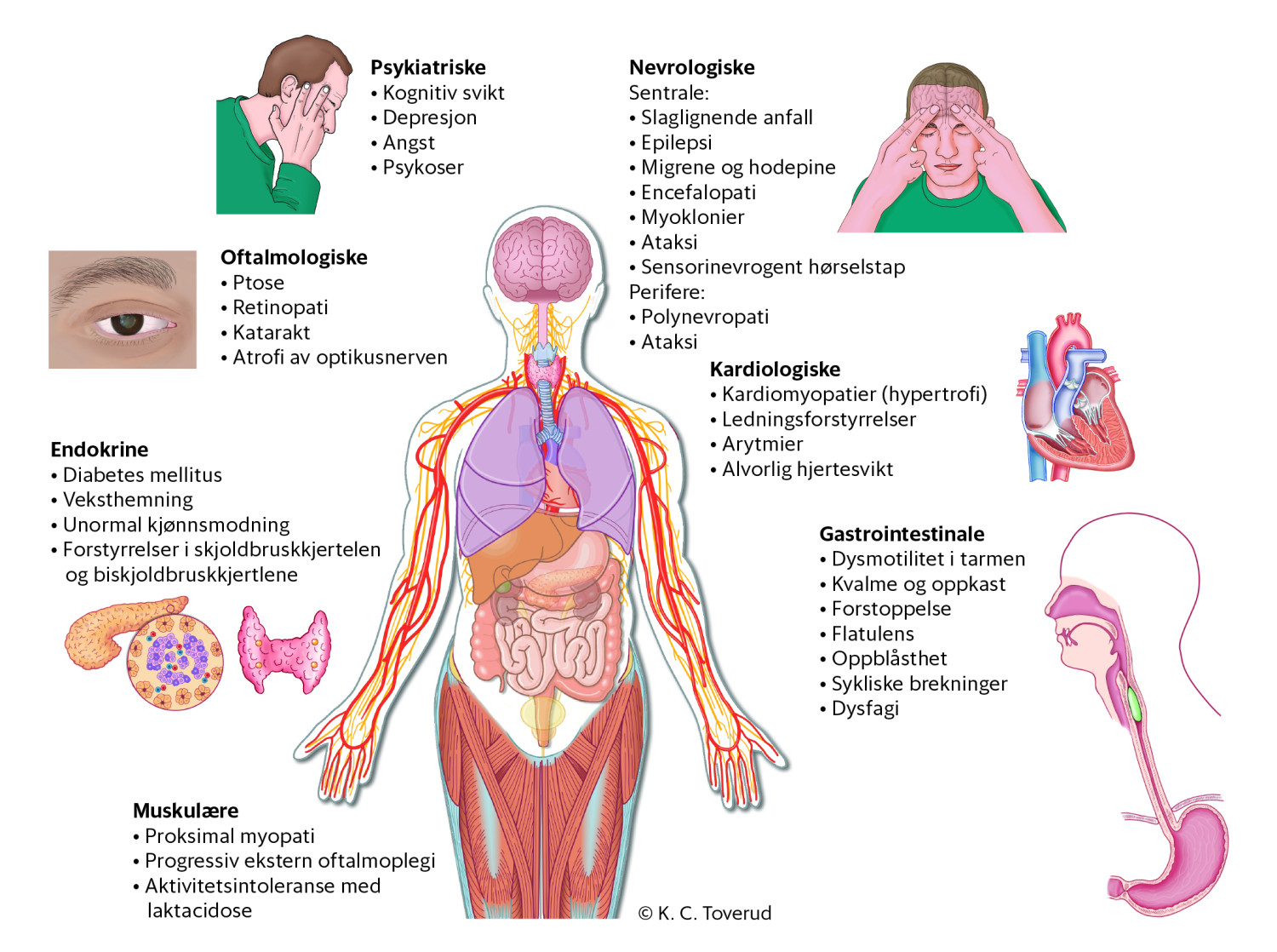 Figur 1 Oversikt over ulike manifestasjoner av m.3243A>G-mutasjonen.