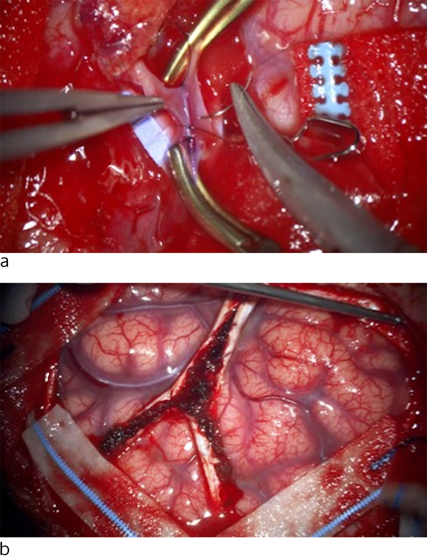 Figur 3 Barnet gjennomgikk bilateral operasjon med kombinert revaskularisering utf&oslash;rt med to ukers mellomrom: direkte&hellip;