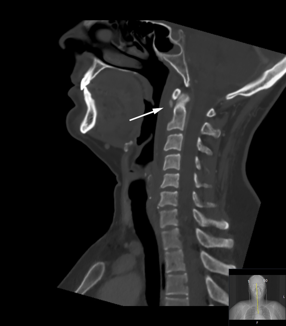 Figure 1 CT cervical spine (bone window) with features typical of calcific tendinitis in the longus colli muscle: round&hellip;