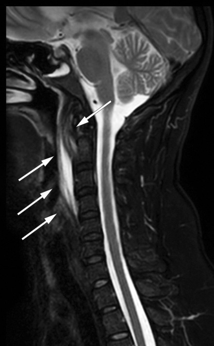 Figure 2 T2-weighted MRI of the cervical spine showing features typical of calcific tendinitis in the longus colli muscle:&hellip;