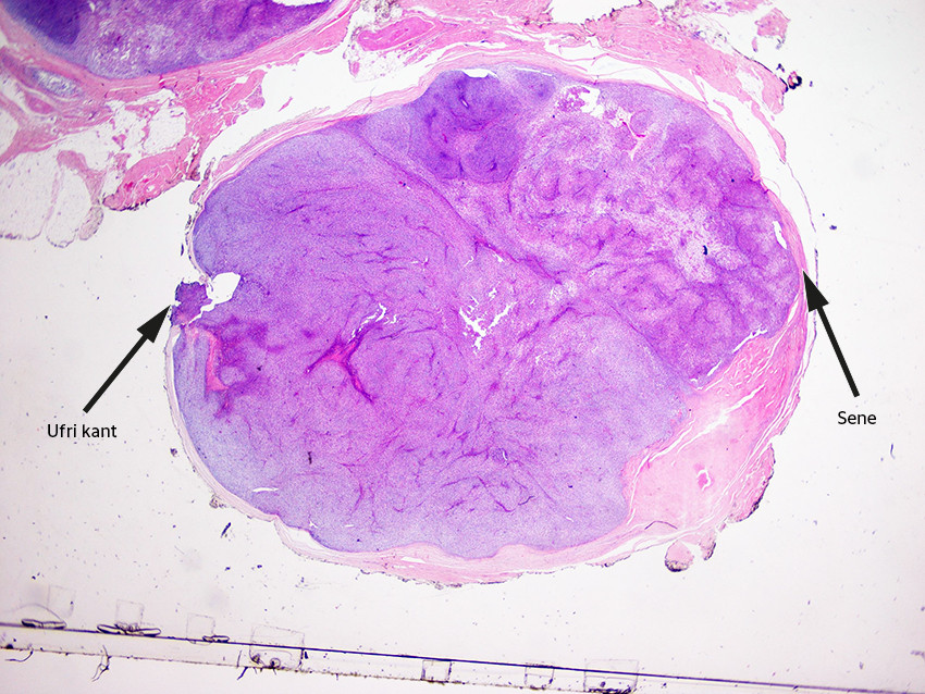 Figur 4 Hematoksylin-eosin-farget snitt av tumor sett med ti gangers forst&oslash;rrelse. Snittet viser tydelig at tumor er solid&hellip;