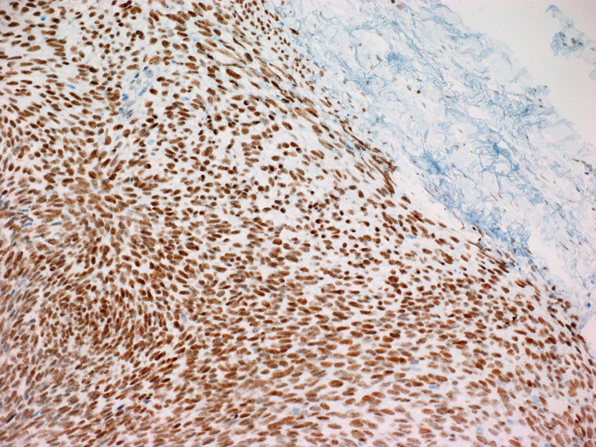 Figur 5 Cellerikt, spolcellet tumorvev med immunhistokjemisk analyse med kraftig kjernefarging mot anti-TLE1 (transducin&hellip;