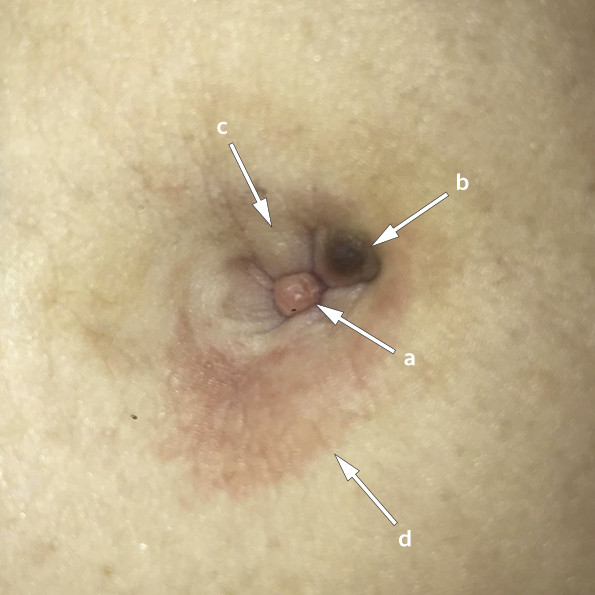 Figur 1 Pasientens navle f&oslash;r f&oslash;rste kontakt med fastlegen. Umbilicus har tre oppfyllinger: a) sentralt en r&oslash;dlig oppfylling,&hellip;