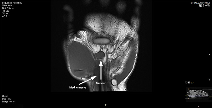 Figure 2 MRI of hand, T1 weighted, coronal plane.