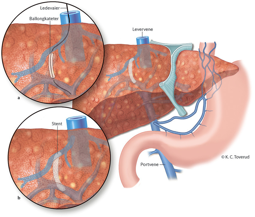 Figur 1 Illustrasjon av innsetting av transjugul&aelig;r intrahepatisk portosystemisk shunt.