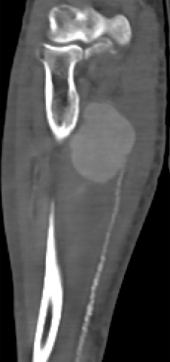 Figure 1 Preoperative CT angiography shows an aneurysm. Calcification and stenosis of the ulnar artery can be seen distal to&hellip;