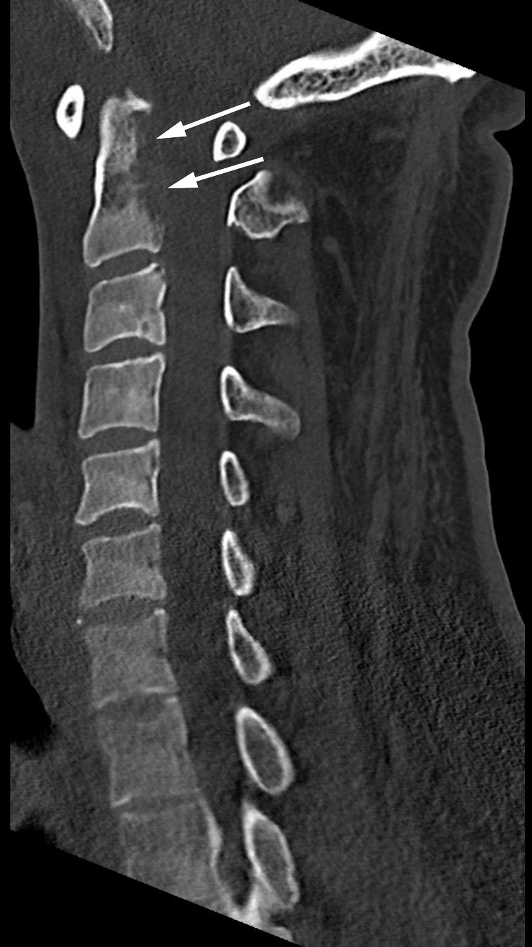 Figur 1 CT av cervikalcolumna (sagittalplan) viser osteolytisk lesjon i C2 (piler).
