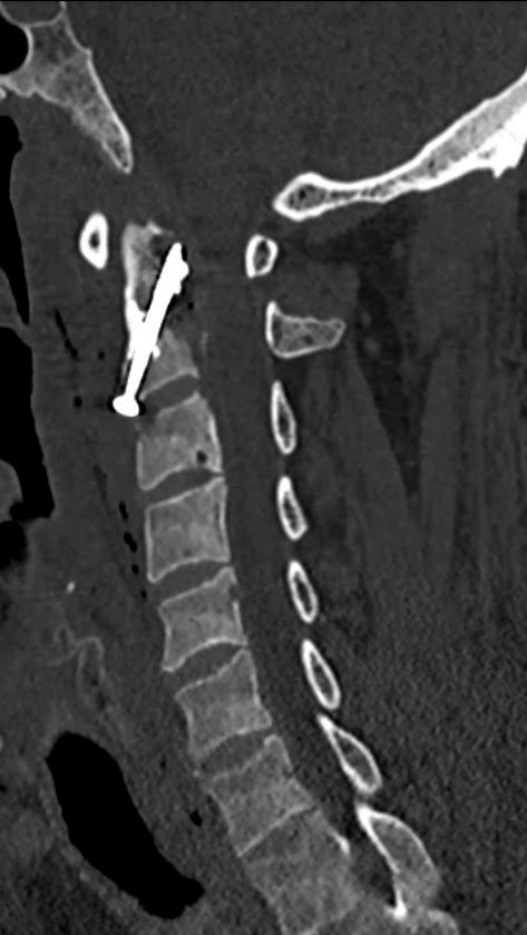 Figur 2 CT av cervikalcolumna med lokal fiksering med sement og skrue i dens axis.