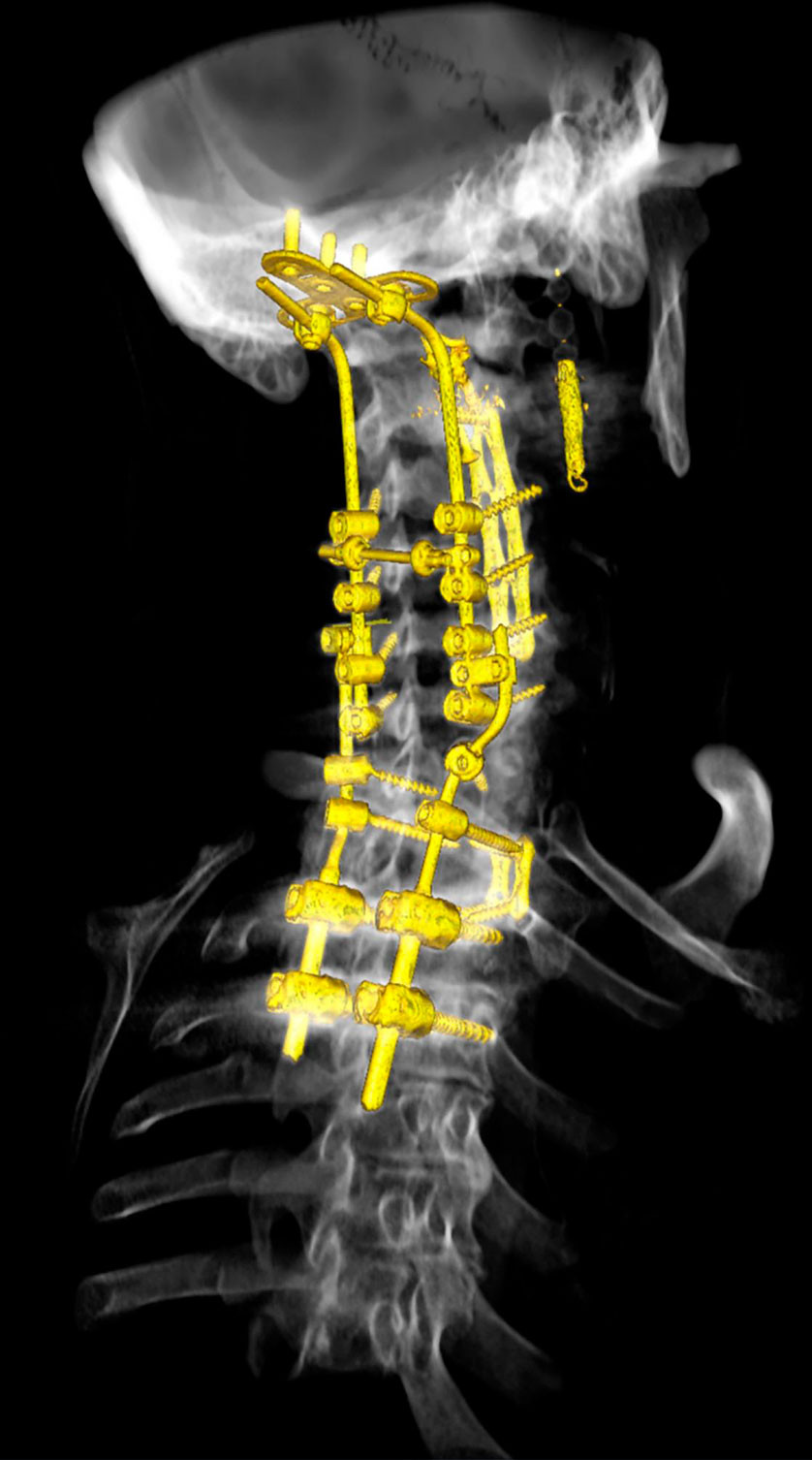 Figur 4 3D-rekonstruksjon av CT tatt etter tredje operasjon viser status etter korpektomi av C3&ndash;Th1, fremre fiksering og&hellip;